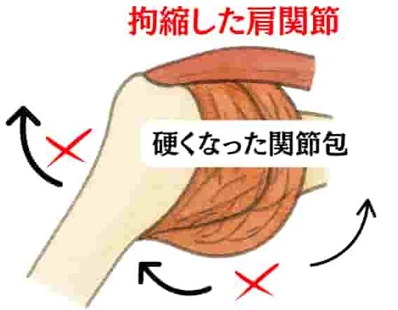 「拘縮した肩関節のイラスト。関節包が硬くなって動きが制限されている様子を示し、四十肩・五十肩の痛みの原因が関節包の滑り（関節包内運動）の悪さにあることを説明する図（姫路市・鍼灸整骨院一心堂）」