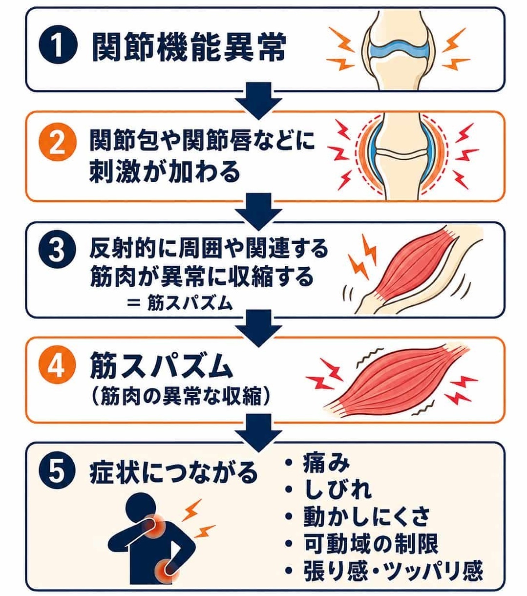 関節包などへの刺激が神経を通して伝わり、反射的に周囲や関連する筋肉が収縮して筋スパズムが起こる流れを説明した図。