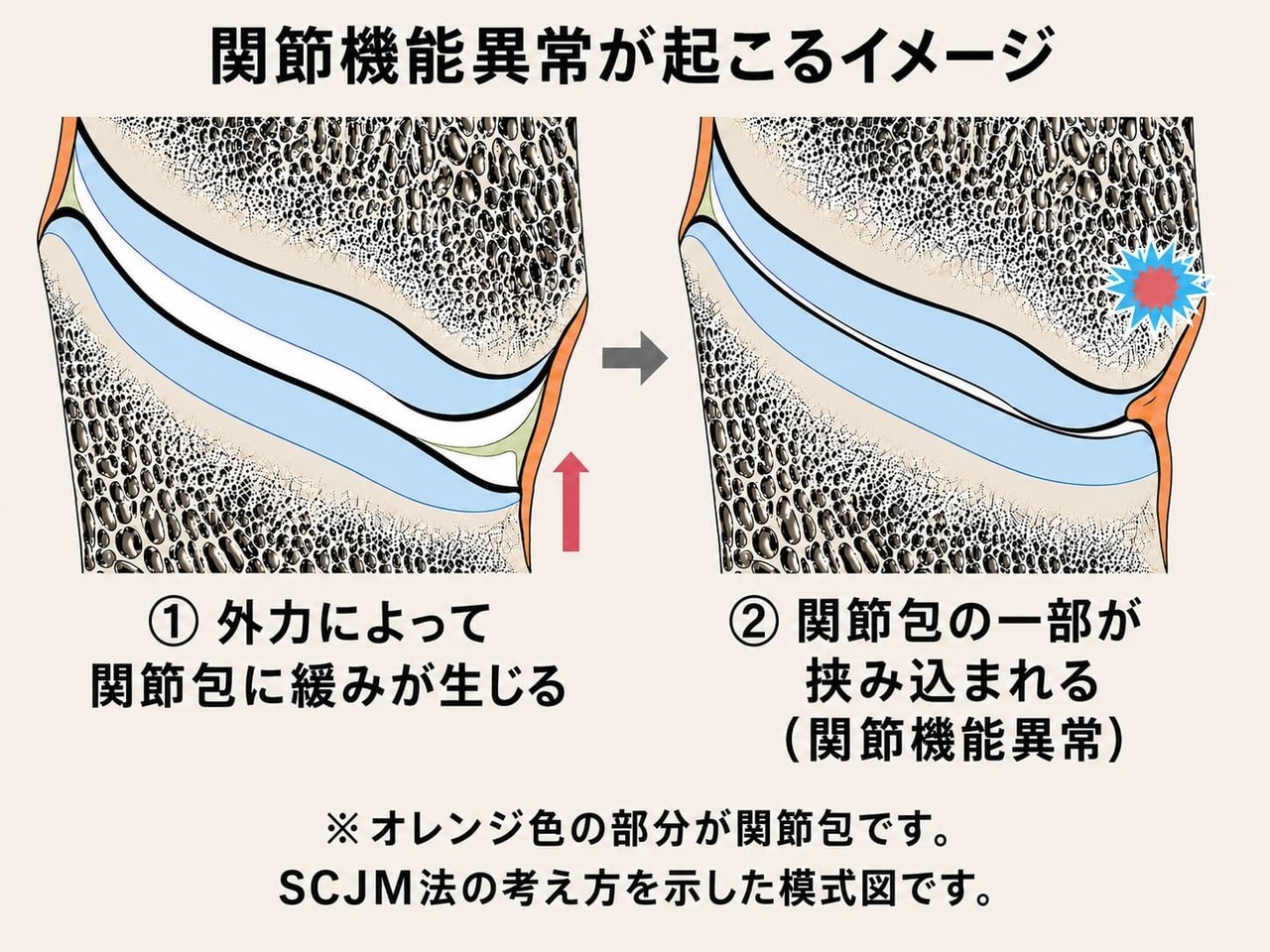 「関節の奥で起きる関節機能異常の説明図」