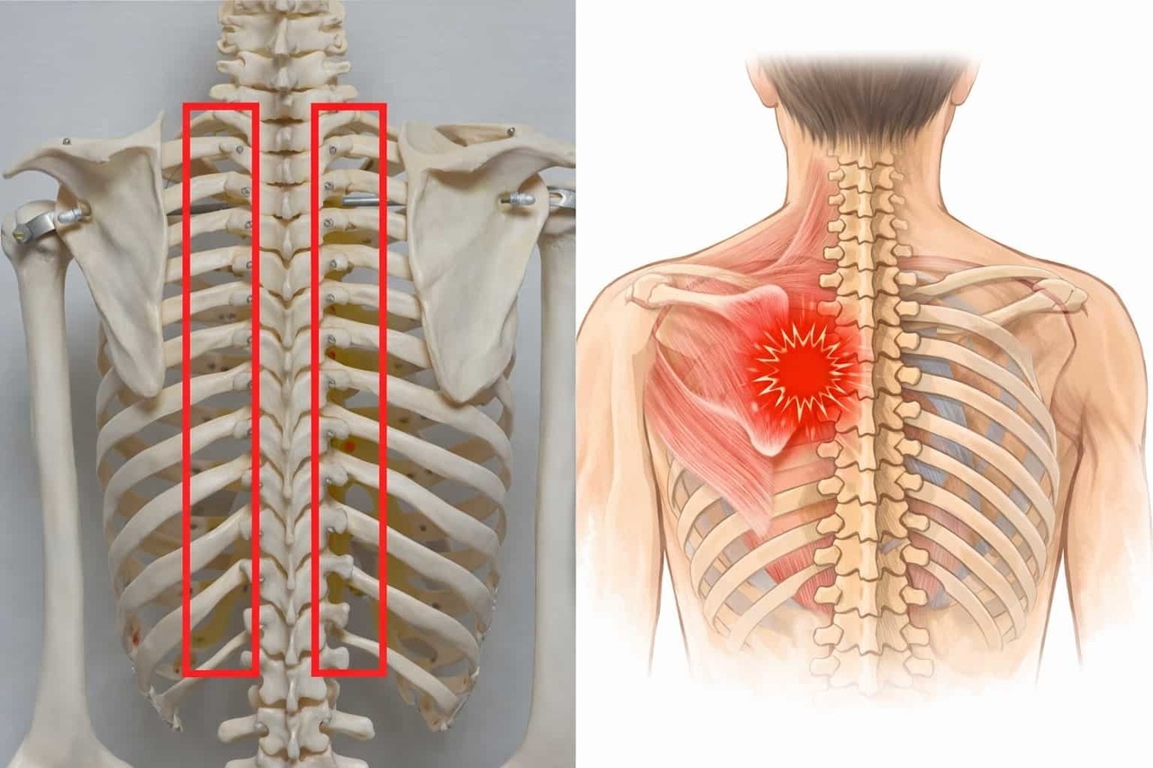 肋椎関節の機能異常によって肩甲骨内側に痛みが出る関連痛のイラスト
