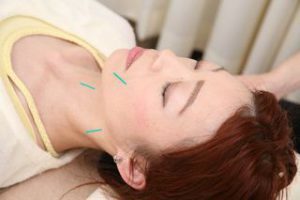 美容鍼で非常に細い鍼を用い、顔まわりの筋肉に働きかけている様子