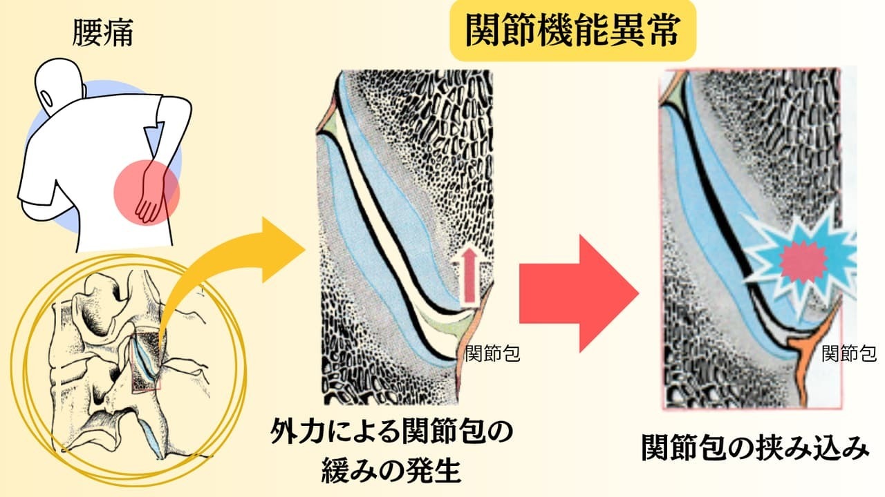 腰痛と関節機能異常の関係を説明した図。仙腸関節や腰椎の関節包に引っかかりが生じ、関節包への刺激によって筋肉が緊張している状態を示しているイメージ。