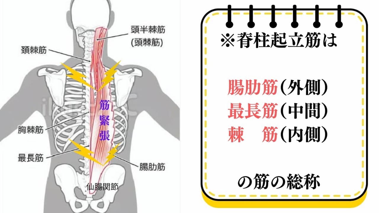 仙腸関節の機能異常により脊柱起立筋が緊張し背中の張りが広がるイラスト