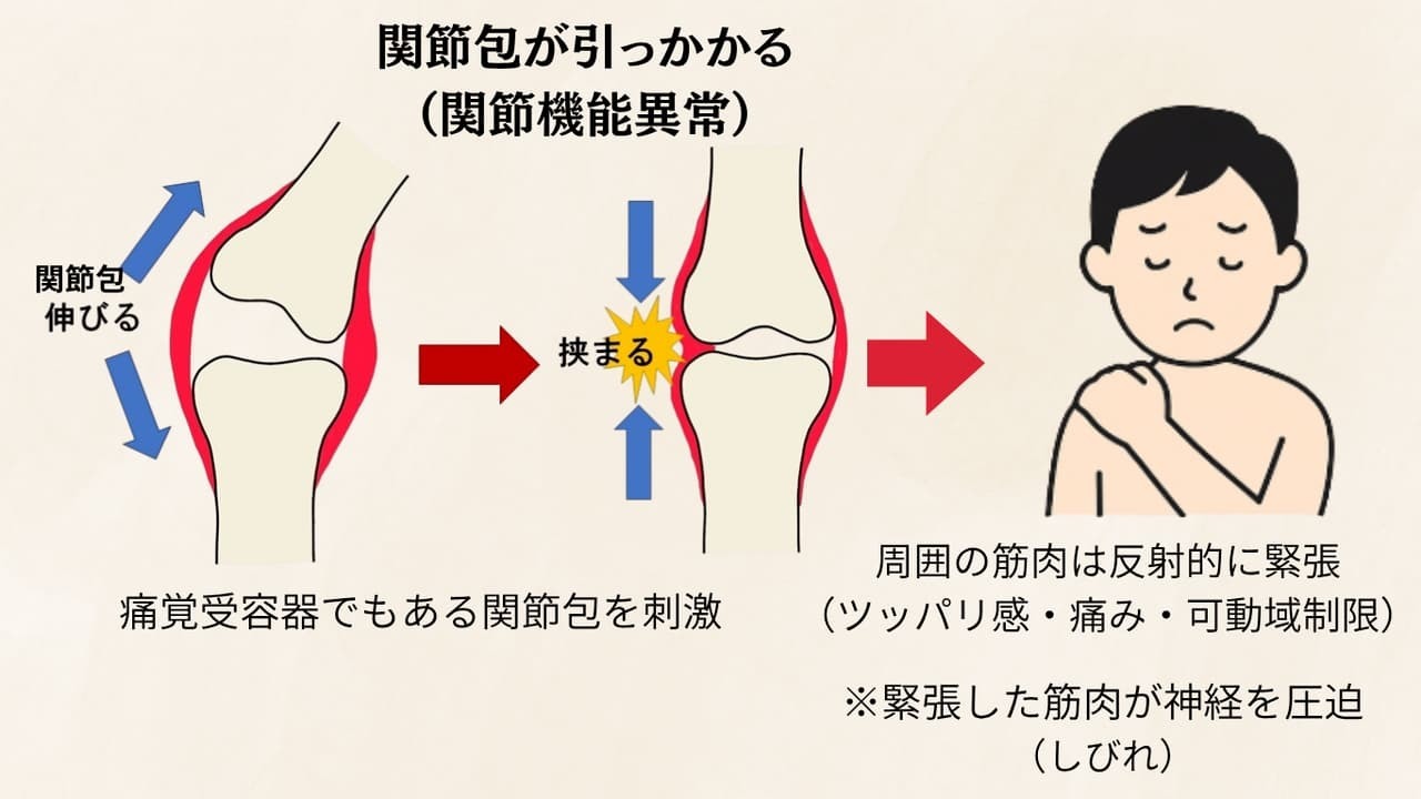 姫路市の鍼灸整骨院一心堂が解説する関節包が引っかかることで起こる関節機能異常の仕組みを示した図。左側は正常な関節で関節包が伸びている様子、中央は関節包が挟まれて刺激されている様子、右側は肩に痛みや不快感を抱える人物のイラスト。下部には『関節包は痛覚受容器でもあり、刺激されると周囲の筋肉が反射的に緊張し、ツッパリ感・痛み・可動域制限が起こる。さらに筋肉が神経を圧迫するとしびれが出ることもある』といった説明が記載されている。