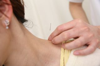 首や肩甲骨周辺に鍼灸施術を行う様子