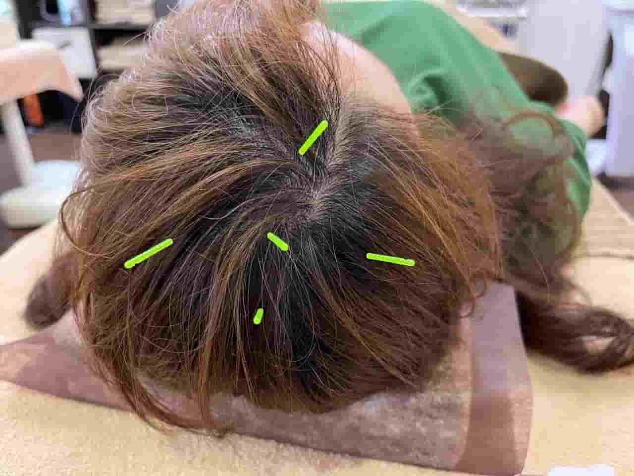 頭部への鍼施術の様子。姫路市の鍼灸整骨院一心堂では、自律神経の働きを整え、ストレスや心因性の要因からくる慢性腰痛の改善をサポートしています。