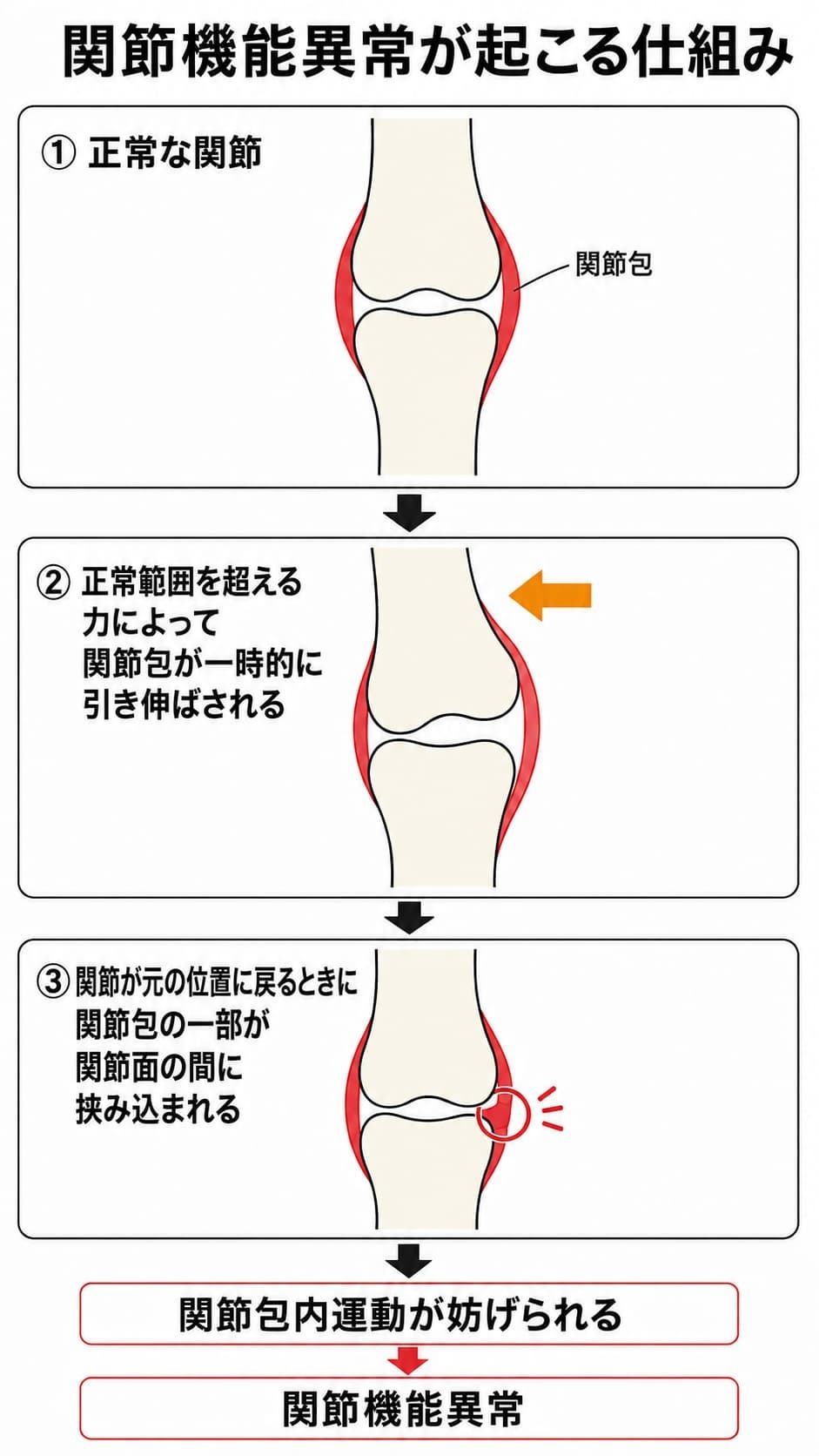 正常範囲を超える力で関節包が一時的に引き伸ばされ、ゆるみが生じた関節包の一部が関節が元の位置に戻る際に関節面の間へ挟み込まれ、関節包内運動が妨げられる流れを説明した図。