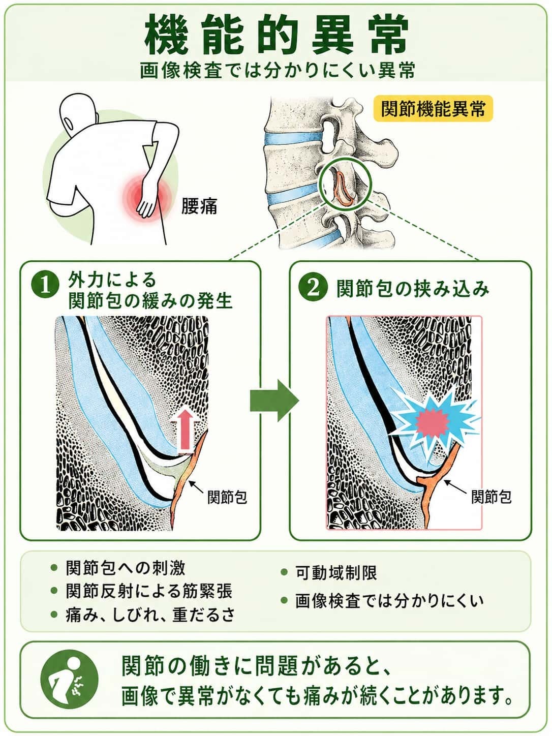 画像検査では分かりにくい機能的異常として、関節包の挟み込みや関節反射による筋緊張、痛みやしびれが続く仕組みを説明する図解