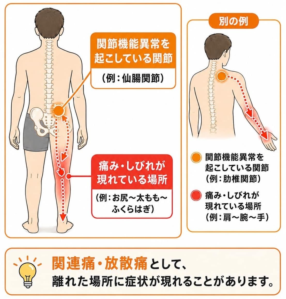 痛みやしびれを感じる場所と、関節機能異常を起こしている関節が離れていることがあることを示した図。仙腸関節の関節機能異常でお尻から太もも・ふくらはぎに症状が現れる例と、肋椎関節の関節機能異常で肩から腕・手に症状が現れる例を示しています