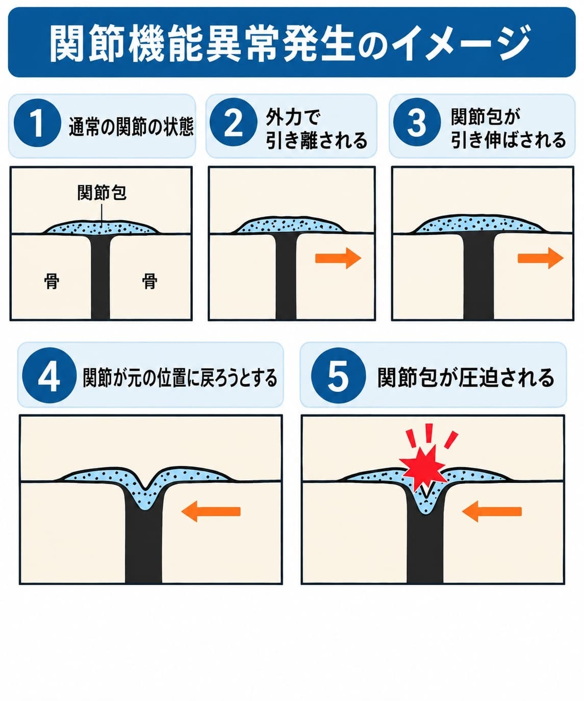 外力で関節包が引き伸ばされ、関節が元の位置に戻る過程で関節包が圧迫されるまでを示した関節機能異常発生のイメージ図