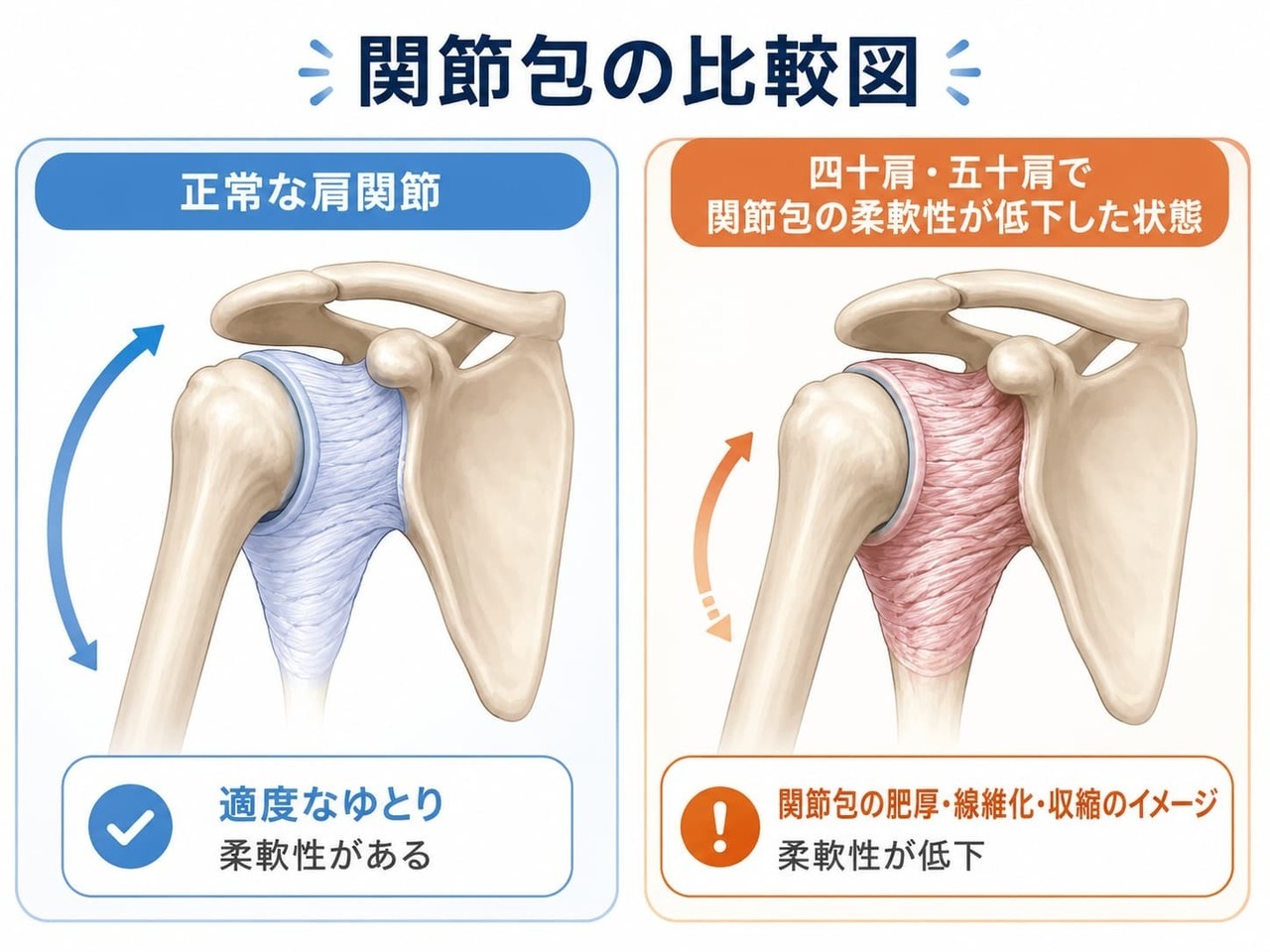 正常な肩関節と四十肩・五十肩の関節包の比較図