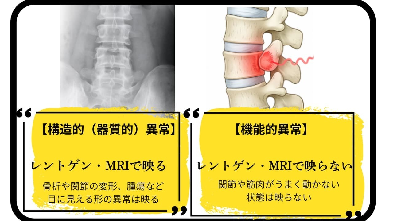 レントゲンに映る構造的異常と映らない機能的異常の比較図