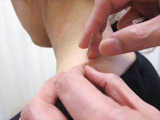 「四十肩・五十肩の炎症期に、痛みの鎮静を目的として鍼灸で対応している施術の様子」