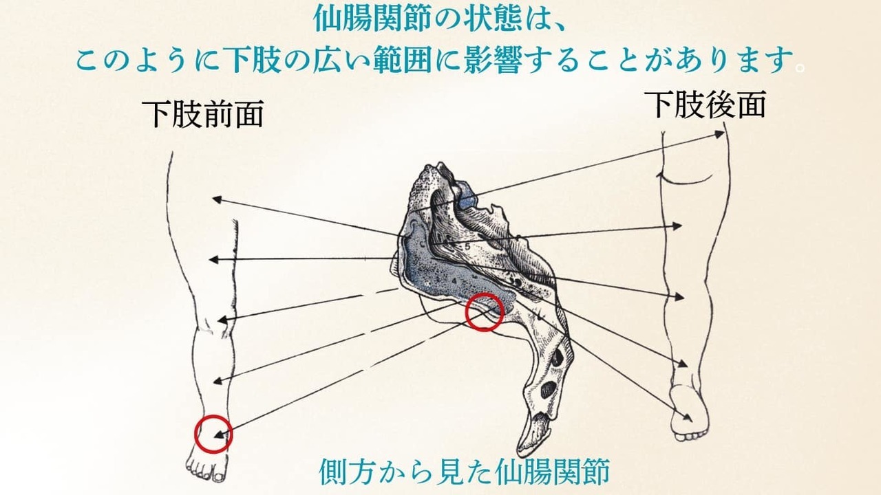 仙腸関節の機能異常による関連痛で足の甲に痛みが出る仕組みの図（姫路市の鍼灸整骨院一心堂）