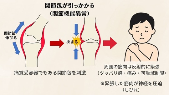 関節包の引っかかりによる関節機能異常が関節反射を起こし筋緊張や痛みにつながる仕組みの図
