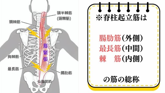 仙腸関節の機能異常により脊柱起立筋が緊張し背中の張りが広がるイラスト