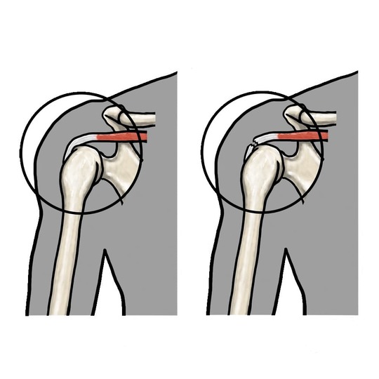 「正常な肩と腱板損傷した肩の比較図：左は腱板が正常に付着し上腕骨が安定、右は腱板断裂により上腕骨が上方へずれた状態を示すイラスト（姫路市・鍼灸整骨院一心堂）」