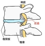 腰椎椎間板ヘルニアの説明図（神経圧迫のメカニズムを示す）