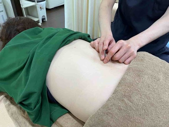 腰部に鍼を打つ施術風景。姫路市の鍼灸整骨院一心堂では、トリガーポイントや経絡に沿った鍼施術で、筋肉の緊張や血流の滞りを改善しています。