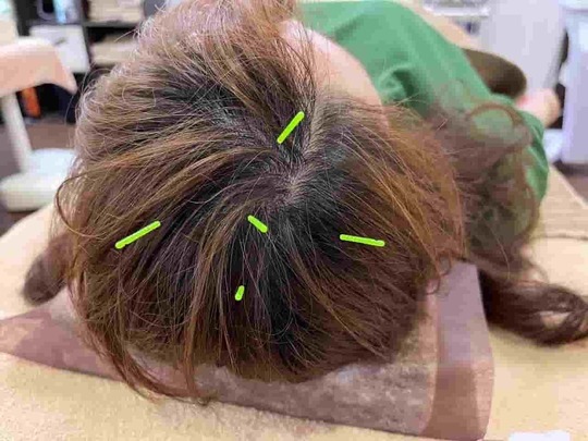 頭部への鍼施術の様子。姫路市の鍼灸整骨院一心堂では、自律神経の働きを整え、ストレスや心因性の要因からくる慢性腰痛の改善をサポートしています。