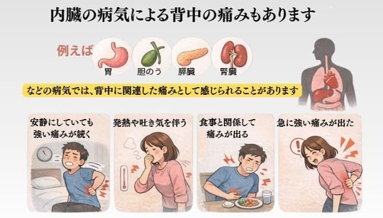 内臓の病気によって背中に痛みが出る関連痛と注意すべき症状を示した図