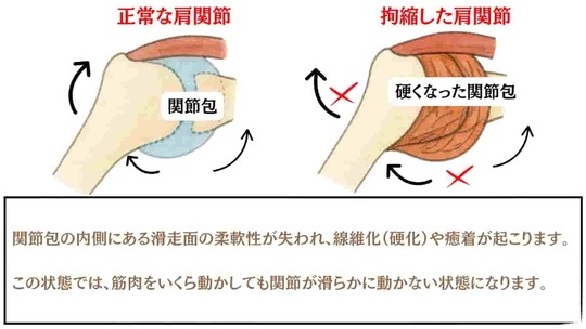 姫路市の鍼灸整骨院一心堂｜四十肩・五十肩で肩が動かなくなる原因を説明する図。炎症が続くと肩関節の奥にある関節包の柔軟性が失われ、線維化や癒着によって可動域が制限される様子をイラストで示している。