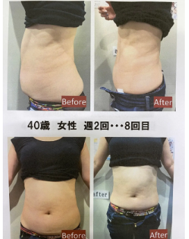 40歳　女性　週２回（８回目）の施術事例befor、After