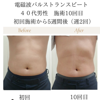 電磁波パルストランスビート　４０代男性　施術10回　初回施術から5週間後（週2回）の施術事例
