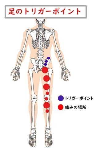 下肢 お尻から足先まで の痛みの原因と施術法 姫路市 鍼灸整骨院一心堂