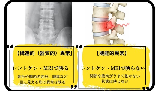 レントゲンに映る構造的異常と映らない機能的異常の比較図