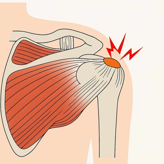 「石灰沈着性腱炎を示す肩のイラスト：腱板内に白い石灰が沈着し、炎症によって肩前面に強い痛みが生じている様子を表した図（姫路市・鍼灸整骨院一心堂）」