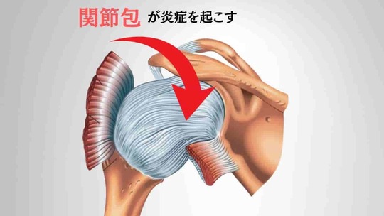 四十肩・五十肩で炎症を起こす肩関節包の位置（姫路市の鍼灸整骨院一心堂）